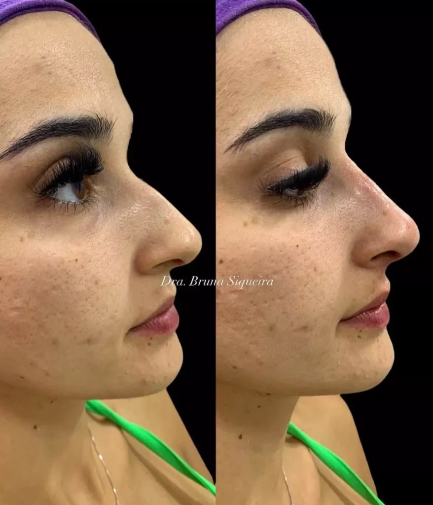 harmonização-facial