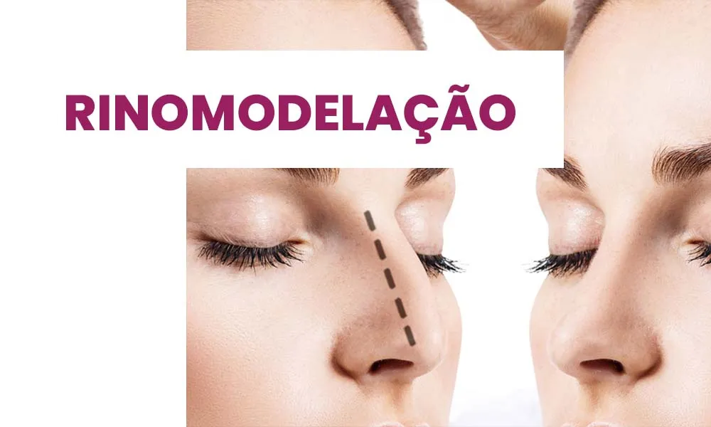rinomodelação