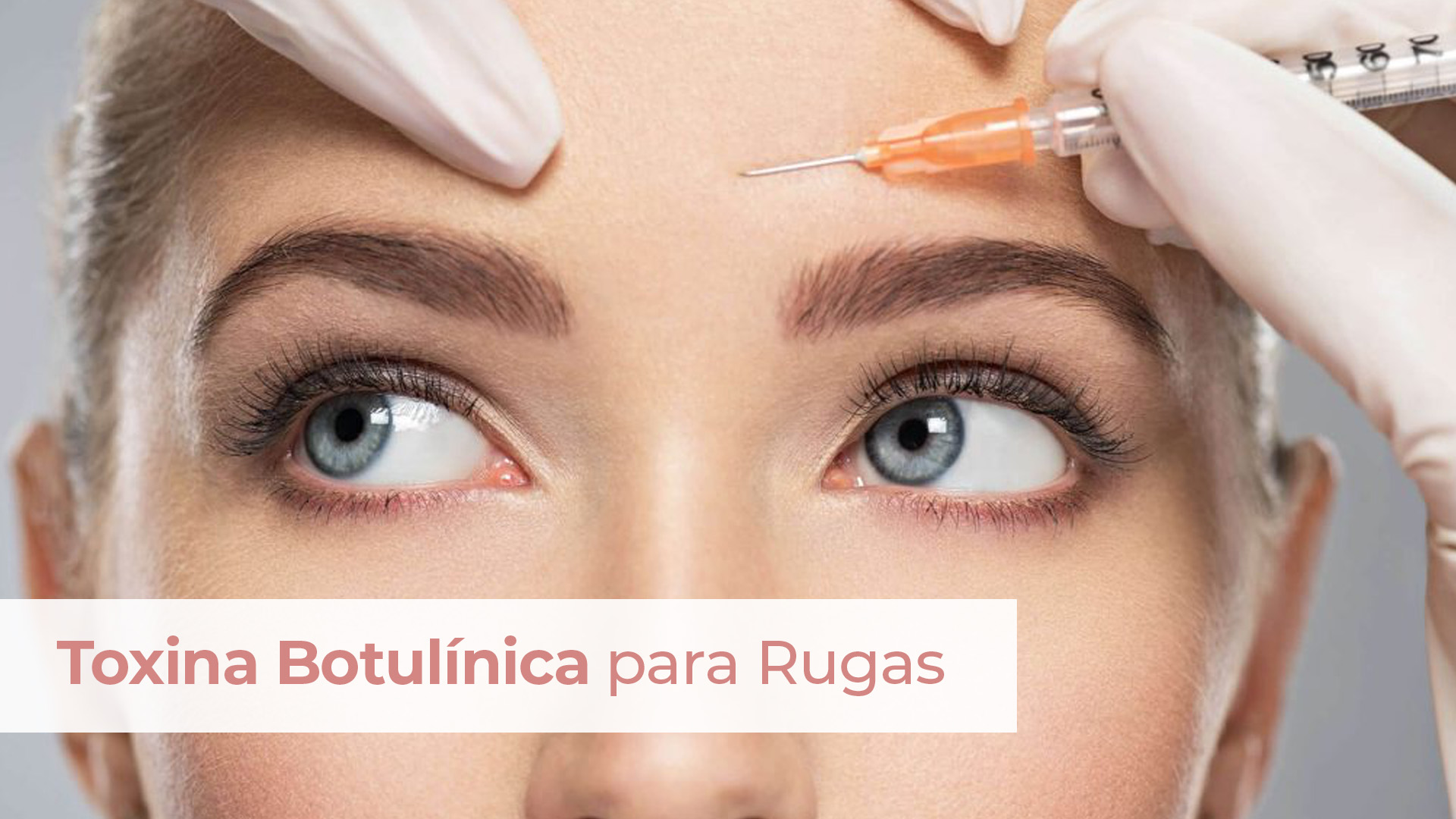 Toxina botulínica para rugas: como funciona, benefícios e resultados naturais