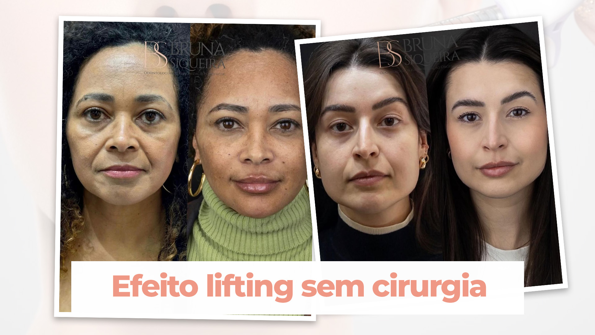 Efeito lifting sem cirurgia: curiosidades sobre os preenchedores