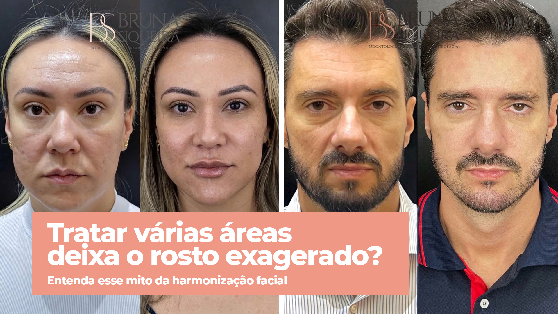Tratar várias áreas deixa o rosto exagerado? Entenda esse mito da harmonização facial