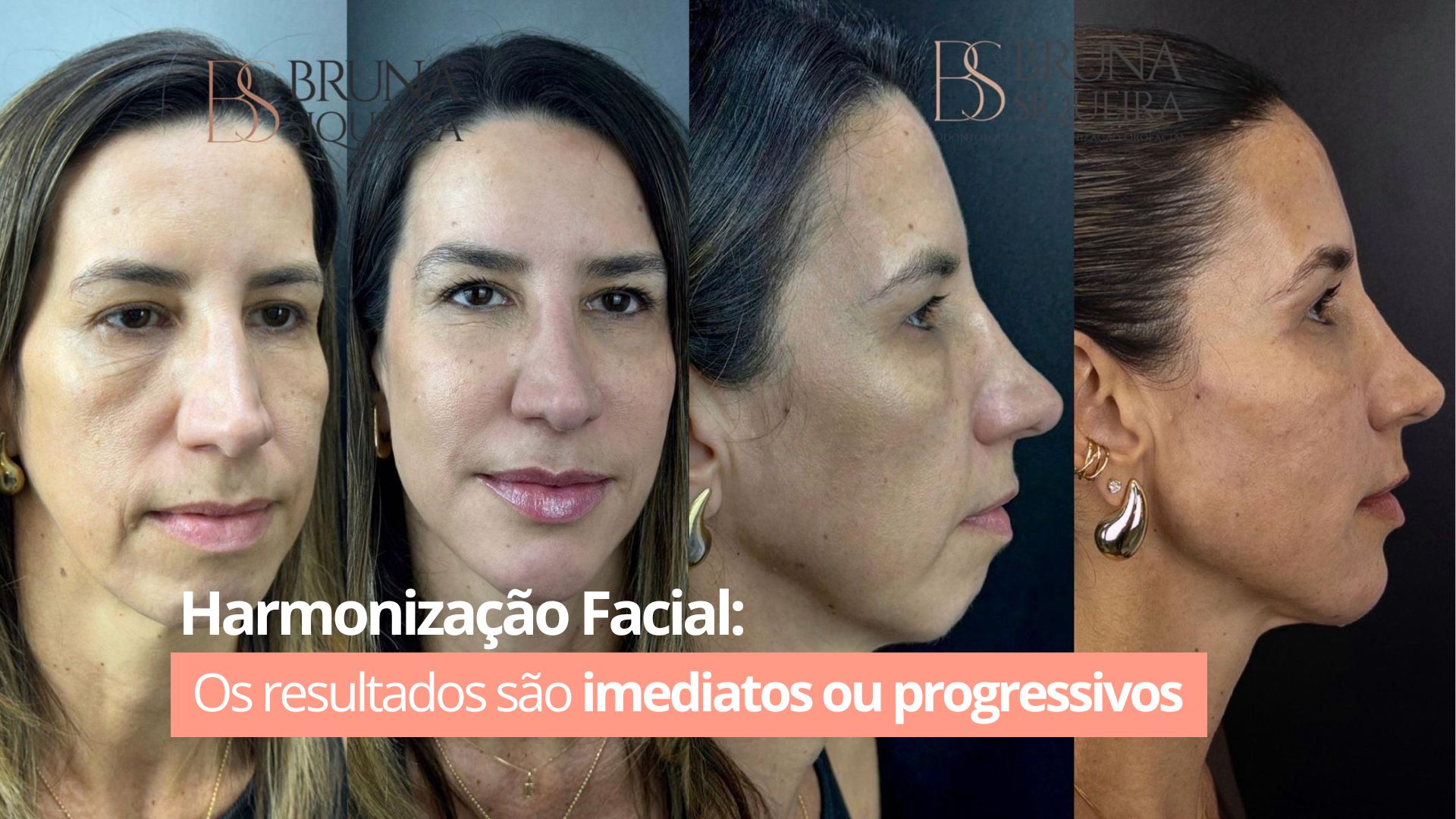 Harmonização Facial: os resultados são imediatos ou progressivos?